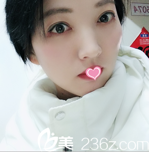 在北京美萊做韓式雙眼皮開眼角祛眼袋第28天效果