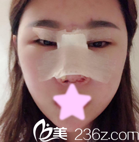 <!--<i data=20240703-sp></i>-->楊明峰給我做隆鼻后第1天照片 <!--<i data=20240703-sp></i>-->楊明峰給我做隆鼻后第1天照片