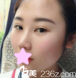 隆鼻日記：記錄我找整形楊明峰做鼻綜合隆鼻1-7天的恢復(fù)過程照片