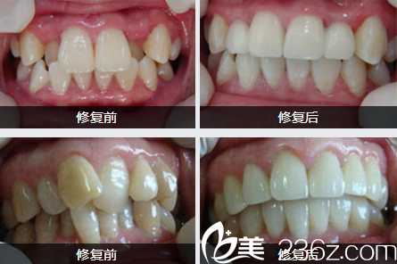 南寧華美牙齒修復(fù)案例 南寧華美牙齒修復(fù)案例