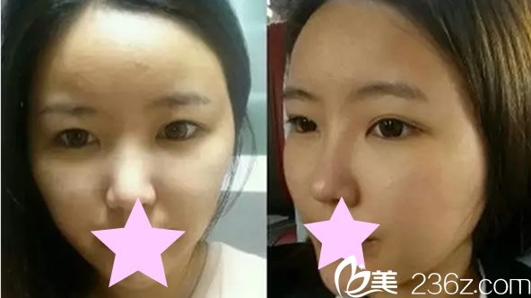 假體隆鼻手術(shù)前 假體隆鼻手術(shù)前