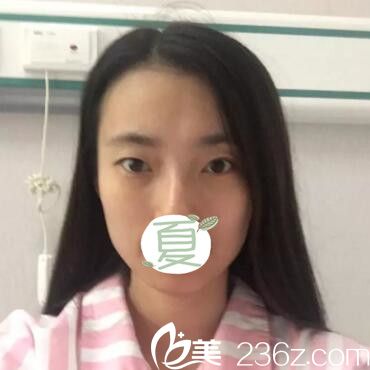 雙眼皮+全臉脂肪填充術前照 雙眼皮+全臉脂肪填充術前照