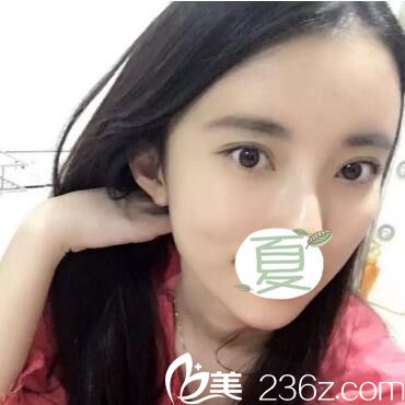 雙眼皮+自體脂肪填充全臉術后20天效果 雙眼皮+自體脂肪填充全臉術后20天效果