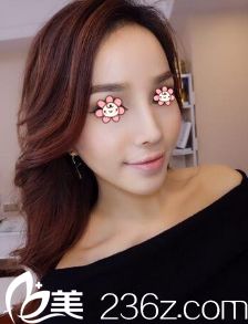 我是塌鼻子短下巴，在貴陽美貝爾醫(yī)生的建議下做了假體隆鼻和假體墊下巴。