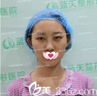雙眼皮+自體脂肪填充全臉術(shù)前照 雙眼皮+自體脂肪填充全臉術(shù)前照