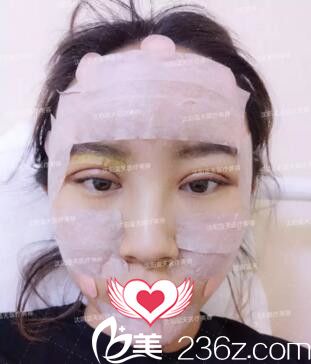 雙眼皮+自體脂肪填充全臉術(shù)后即刻效果 雙眼皮+自體脂肪填充全臉術(shù)后即刻效果