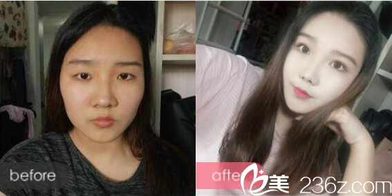 廣州荔醫(yī)整形醫(yī)院李增產(chǎn)做的雙眼皮案例 廣州荔醫(yī)整形醫(yī)院李增產(chǎn)做的雙眼皮案例