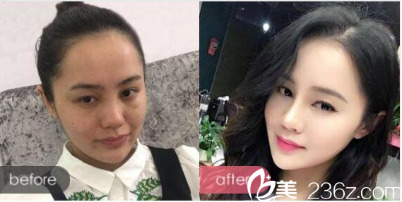 廣州荔醫(yī)整形醫(yī)院李增產(chǎn)做的隆鼻案例 廣州荔醫(yī)整形醫(yī)院李增產(chǎn)做的隆鼻案例