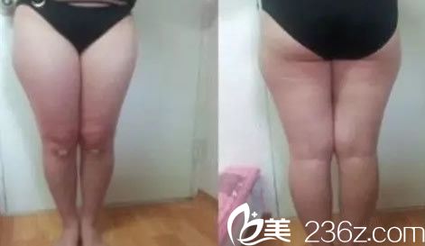 蘭州韓美整形美容大腿吸脂前 蘭州韓美整形美容大腿吸脂前