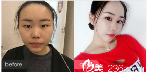 廣州荔醫(yī)整形美容醫(yī)院曾德浩做的雙眼皮案例 廣州荔醫(yī)整形美容醫(yī)院曾德浩做的雙眼皮案例