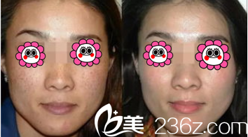 韓國(guó)韓美人<!--<i data=20240703-sp></i>-->皮秒祛斑案例 韓國(guó)韓美人<!--<i data=20240703-sp></i>-->皮秒祛斑案例