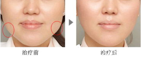 韓國(guó)韓美人<!--<i data=20240703-sp></i>-->瘦臉案例 韓國(guó)韓美人<!--<i data=20240703-sp></i>-->瘦臉案例