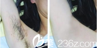 韓國(guó)韓美人<!--<i data=20240703-sp></i>-->脫毛案例 韓國(guó)韓美人<!--<i data=20240703-sp></i>-->脫毛案例