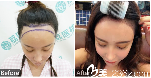 廣州荔醫(yī)整形美容醫(yī)院尚俊做的發(fā)際線種植案例 廣州荔醫(yī)整形美容醫(yī)院尚俊做的發(fā)際線種植案例