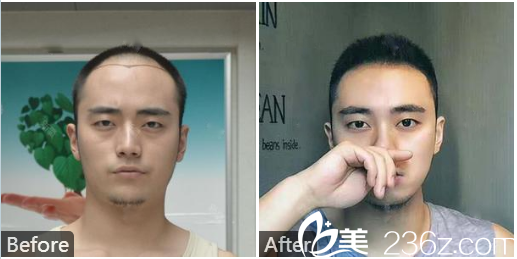 廣州荔醫(yī)整形美容醫(yī)院尚俊做的男士種植發(fā)際線案例 廣州荔醫(yī)整形美容醫(yī)院尚俊做的男士種植發(fā)際線案例