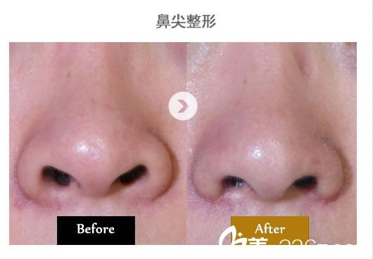 鼻頭鼻尖整形對(duì)比圖