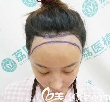 廣州荔醫(yī)整形美容醫(yī)院植發(fā)術(shù)前 廣州荔醫(yī)整形美容醫(yī)院植發(fā)術(shù)前