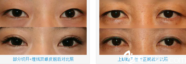 南榮午院長雙眼皮案例 南榮午院長雙眼皮案例