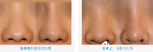 韓國JH整形醫(yī)院南榮午隆鼻案例 韓國JH整形醫(yī)院南榮午隆鼻案例