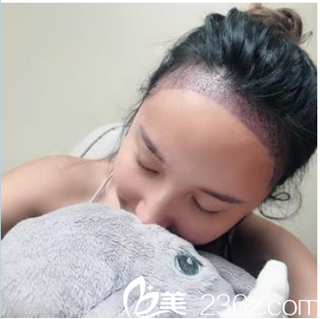 在廣州荔醫(yī)種植發(fā)際線天 在廣州荔醫(yī)種植發(fā)際線天