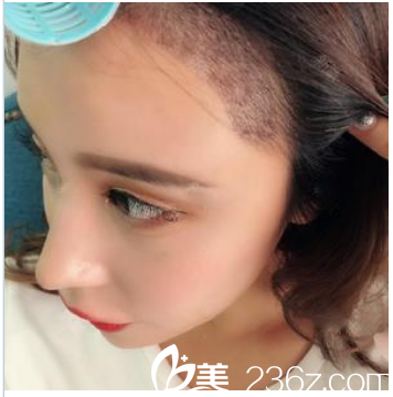 在廣州荔醫(yī)種植發(fā)際線術(shù)后半個(gè)月 在廣州荔醫(yī)種植發(fā)際線術(shù)后半個(gè)月