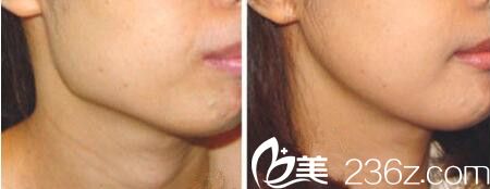 下頜角整形前后對(duì)比效果