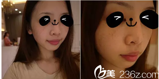 在韓國(guó)韓美人祛斑前樣子 在韓國(guó)韓美人祛斑前樣子