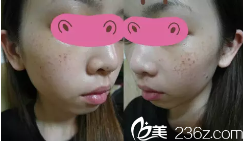 在韓國(guó)韓美人祛斑第3天效果 在韓國(guó)韓美人祛斑第3天效果