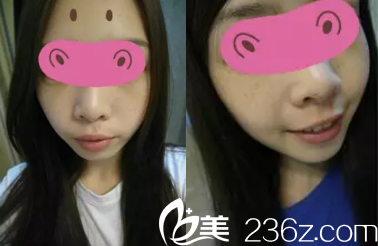 分享我在韓國(guó)韓美人找趙成杰激光祛雀斑第32天真實(shí)效果