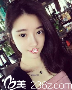 南榮午全切雙眼皮修復(fù)術(shù)后半個月 南榮午全切雙眼皮修復(fù)術(shù)后半個月