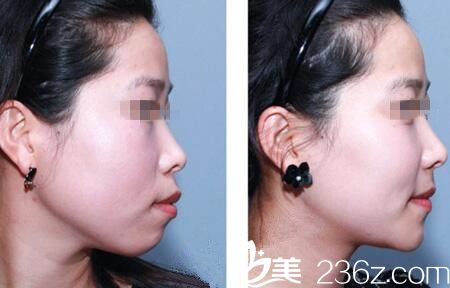 真人突嘴矯正+下頜縮短整形前后對比效果 真人突嘴矯正+下頜縮短整形前后對比效果