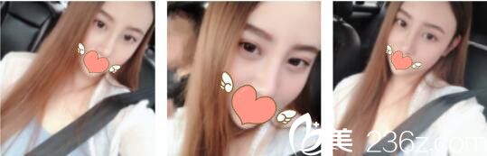 韓國WELLS整形外科李秉夏線雕鼻取出+鼻綜合真人案例術(shù)后一個月 韓國WELLS整形外科李秉夏線雕鼻取出+鼻綜合真人案例術(shù)后一個月