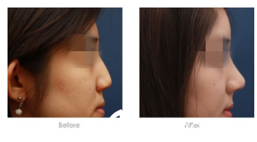 隆鼻前后對(duì)比圖