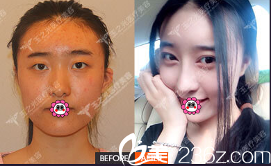 北京潤(rùn)美玉之光面部脂肪填充雙眼皮 北京潤(rùn)美玉之光面部脂肪填充雙眼皮