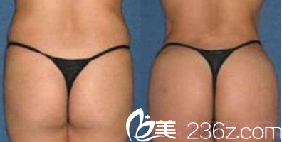 北京潤(rùn)美玉之光脂肪豐臀 北京潤(rùn)美玉之光脂肪豐臀