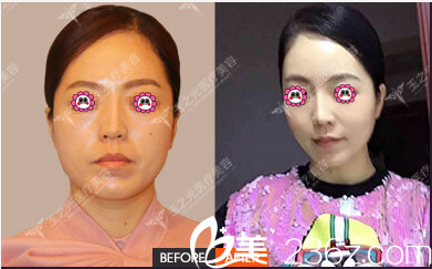 北京潤(rùn)美玉之光面部吸脂 北京潤(rùn)美玉之光面部吸脂