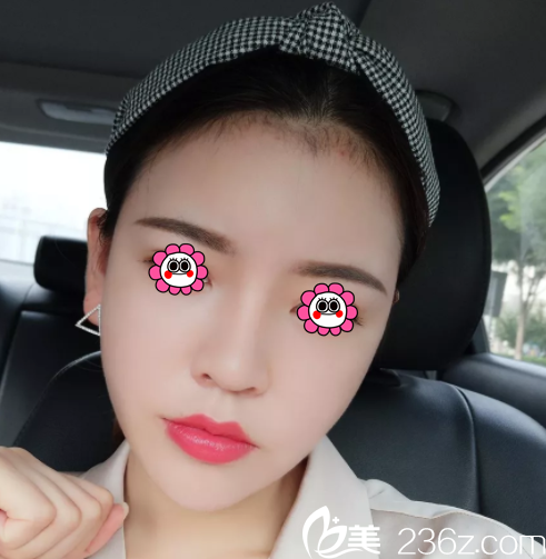 北京潤美玉之光面部吸脂第18天效果 北京潤美玉之光面部吸脂第18天效果