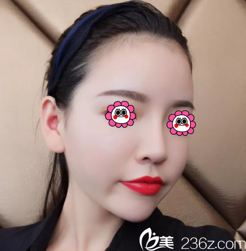 北京潤美玉之光做臉部吸脂第31天效果 北京潤美玉之光做臉部吸脂第31天效果