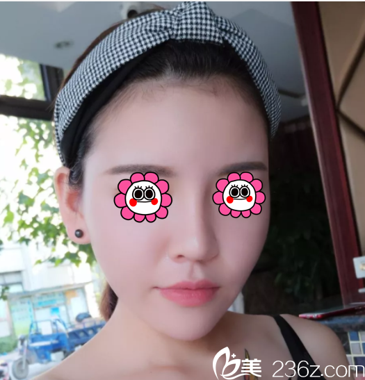 北京潤美玉之光面部吸脂案例 北京潤美玉之光面部吸脂案例