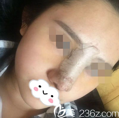 術(shù)后第四天