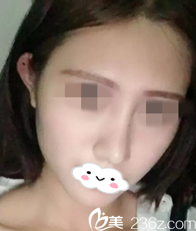 常德瑞美好還是德美好？在閨蜜的推薦下終于下定決心找常德瑞美整形美容醫(yī)院肖興平院長(zhǎng)做鼻綜合，術(shù)后30天自然無(wú)痕、立體感十足