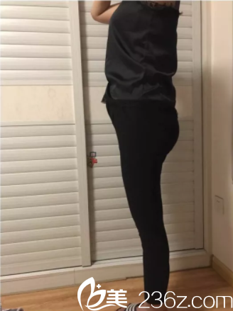 北京潤美玉之光腿部吸脂第16天效果 北京潤美玉之光腿部吸脂第16天效果