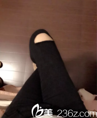 北京潤美玉之光吸脂瘦腿案例 北京潤美玉之光吸脂瘦腿案例