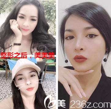 巴諾巴奇整形外科醫(yī)院輪廓三件套案例