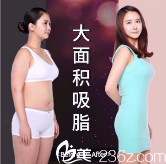 韓國麗妍K整形醫(yī)院減肥吸脂案例