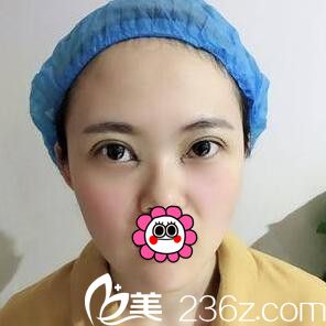 3D媚眼綜合手術(shù)術(shù)后即刻效果