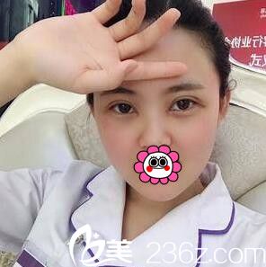 3D媚眼綜合術(shù)術(shù)后一周恢復(fù)效果