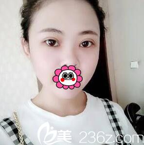 蔣新力做的3D媚眼綜合手術(shù)術(shù)后半個月恢復(fù)效果