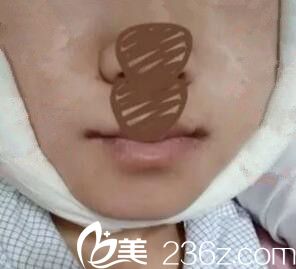 下頜角整形術(shù)后第二天效果