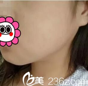 下頜角整形術(shù)后一周恢復(fù)程度